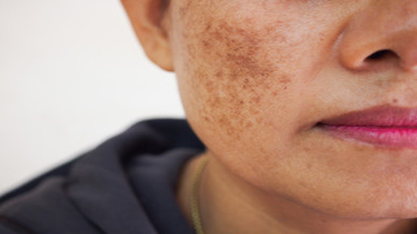 Woman with facial pigmentation and dark spots on her cheeks.